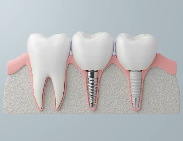The Future of Tooth Replacement: Advances in Dental Implant Technology