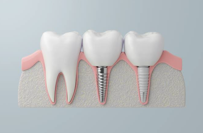 The Future of Tooth Replacement: Advances in Dental Implant Technology
