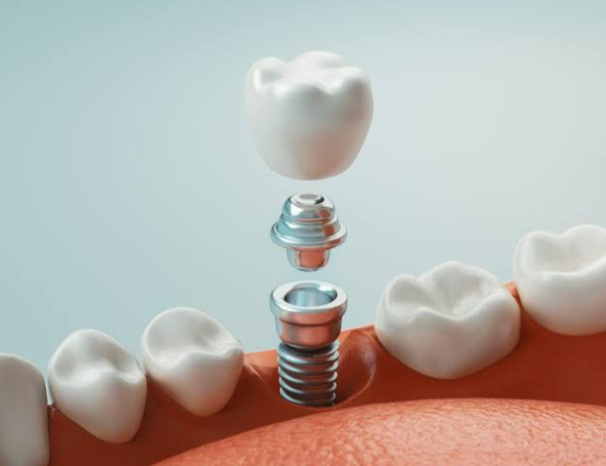 Changing Smiles in St. Louis, Missouri: How Dental Implants Transform Lives