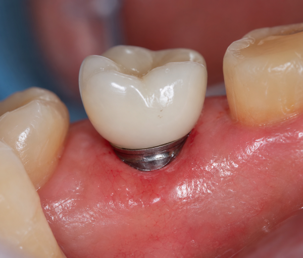Dental Implant Warning Signs: A Practical Guide To Gum Health And Timely Care