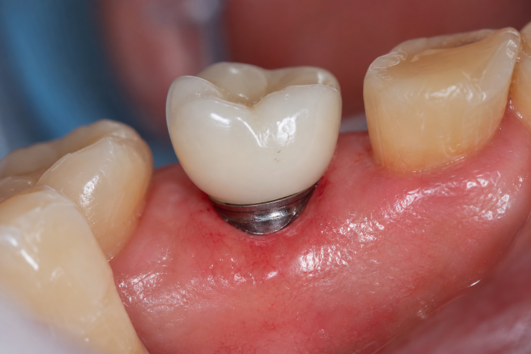 Dental Implant Warning Signs: A Practical Guide To Gum Health And Timely Care